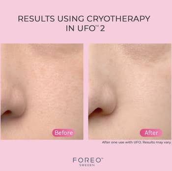 person before and after using cryotherapy on ufo 2