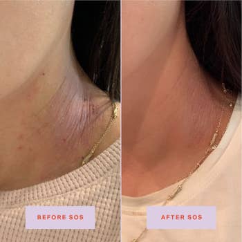 a before and after of a neck with skin irritation 