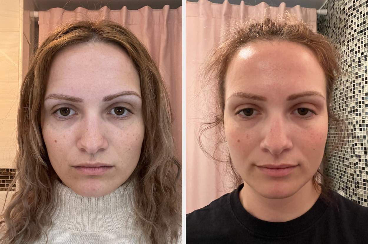 I Tried Botox For My TMJ And I’m Never Looking Back