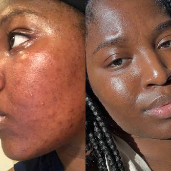 A readers scarred skin before using exfoliants regularly / A readers clear skin after using the product on and off for two years