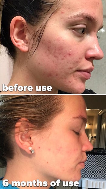 a reviewer's before and after use in 6 months. the after is clearer and less red