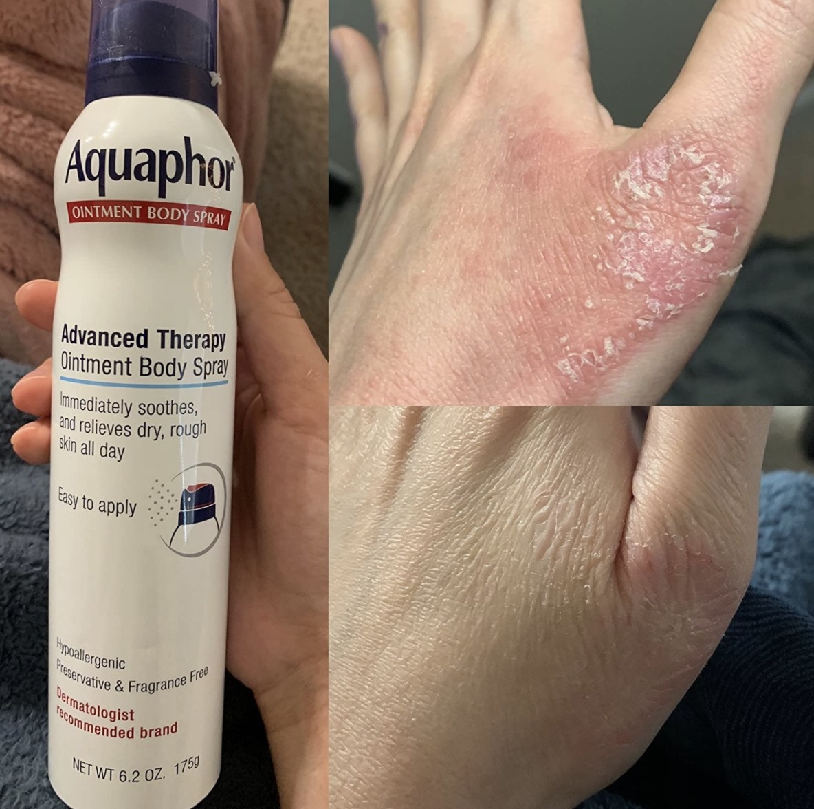 reviewer holding the bottle of Aquaphor spray next to a before-and-after image showing how it has healed their dry skin
