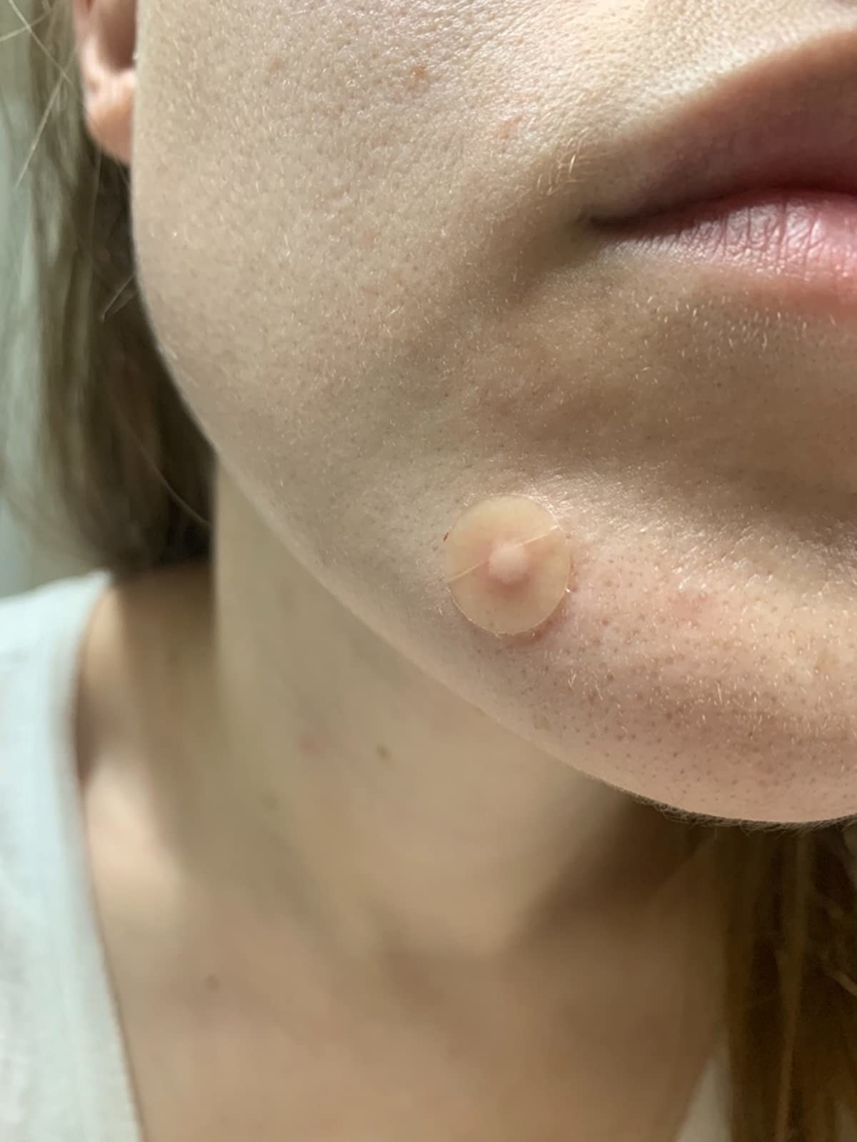image of pus-filled acne patch on reviewer's face