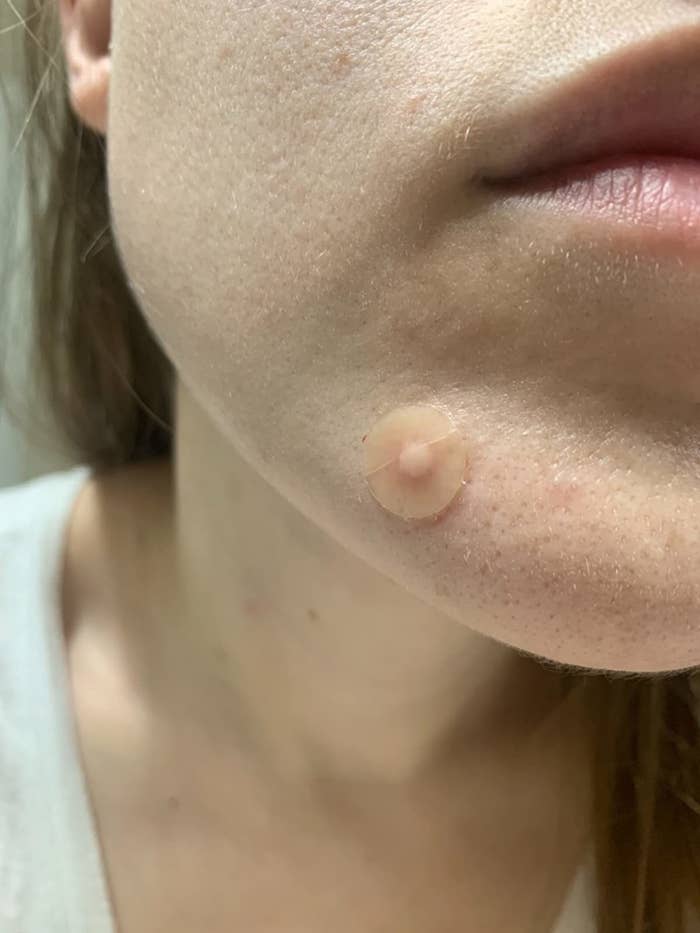image of pus-filled acne patch on reviewer&#x27;s face