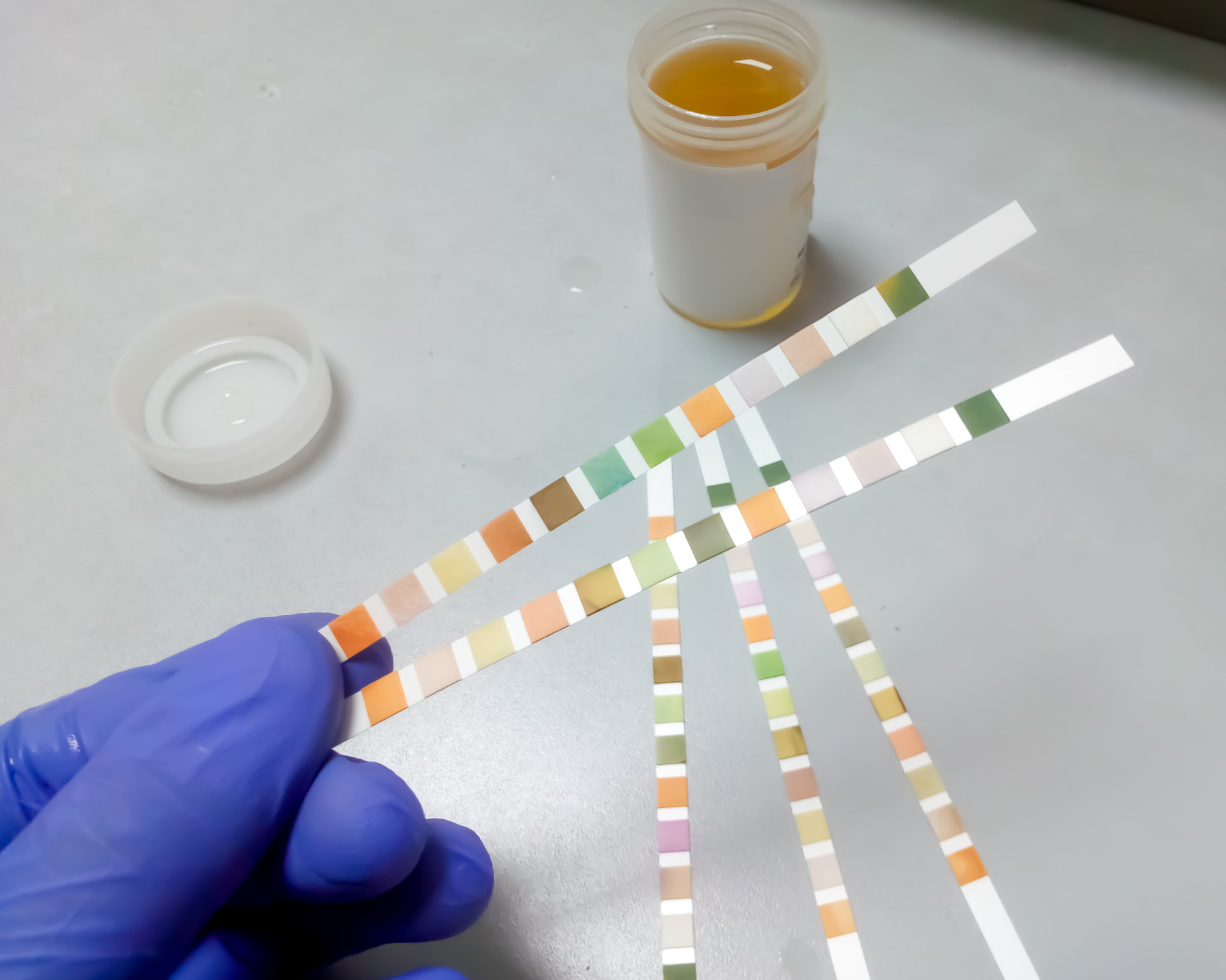 A urine sample and test strips