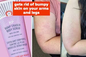 KP bump eraser on the left and a before and after shot of skin on the right