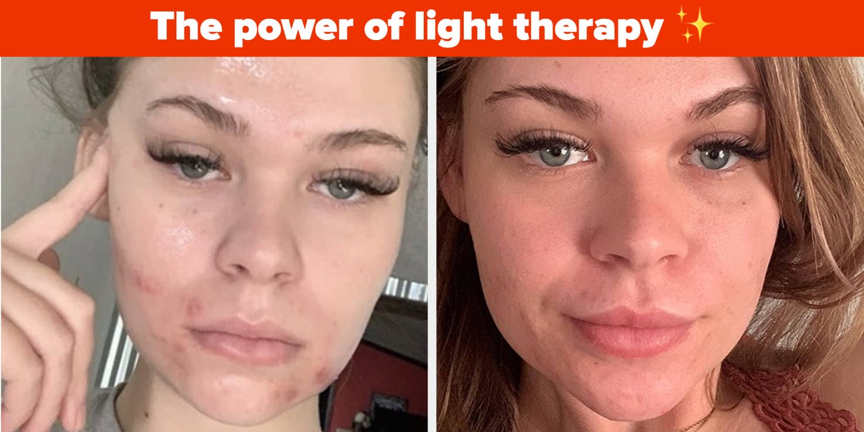 28 Beauty Products With Before-And-After Photos That’ll Give
You Hope If You’ve Been Battling Acne For Years