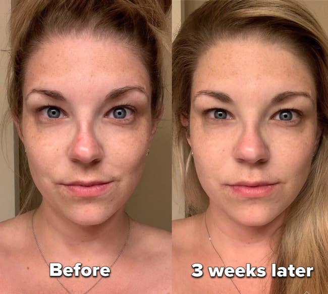 before photo of a reviewer's face, and an after photo showing their skin looking more even and with less redness three weeks later