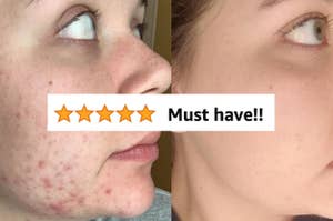a reviewer's before and after showing how their acne went away using cerave
