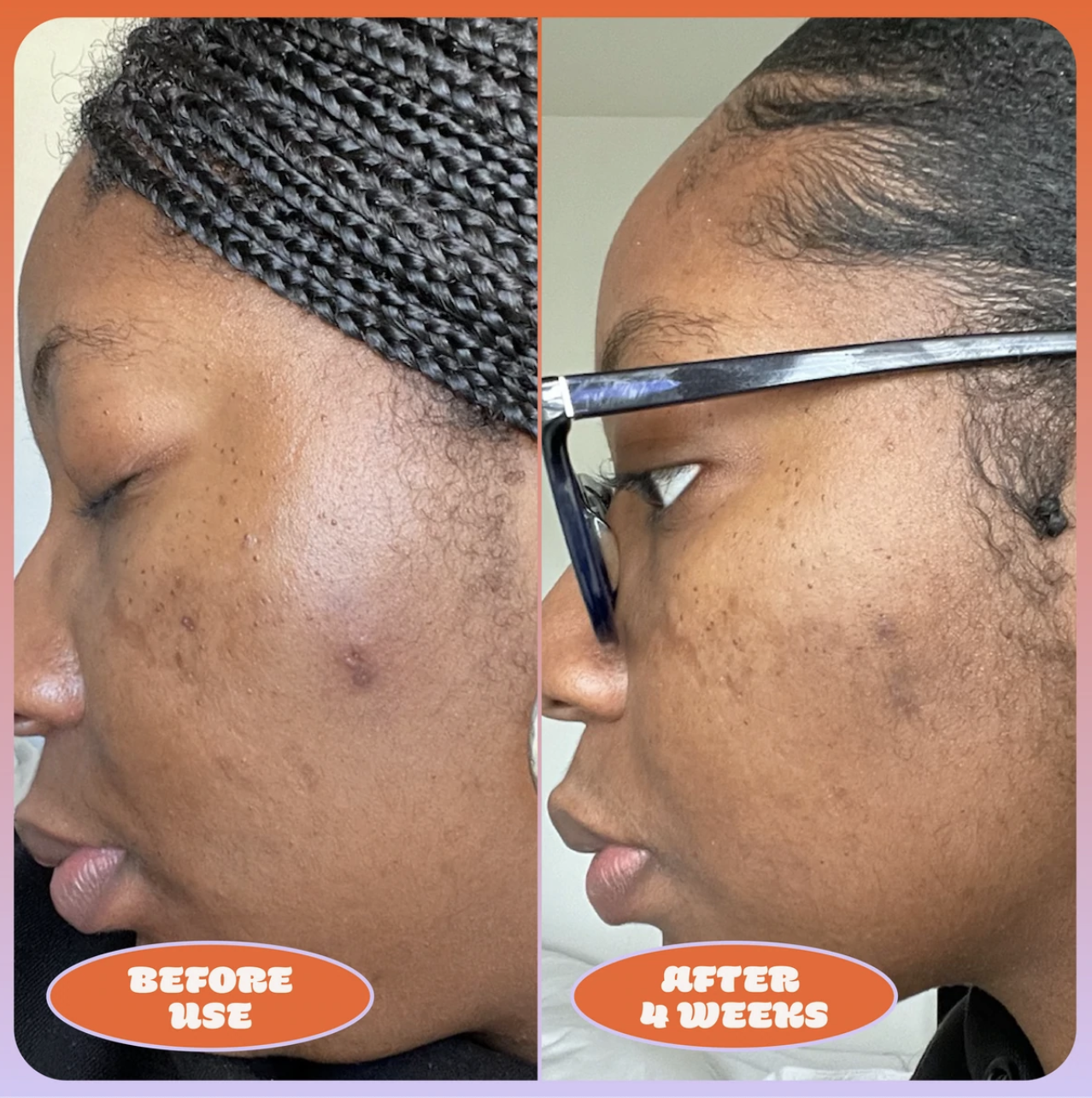 a before and after photo of a darker skintone that looks smoother after four weeks of using the serum