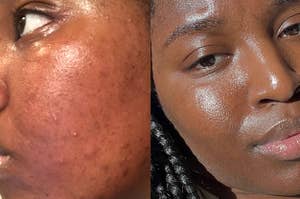 A reviewer's blemished skin before using exfoliants / A reviewer's nourished skin after exfoliating and using sunscreen