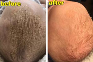 a before and after photo for a cradle cap comb and brush