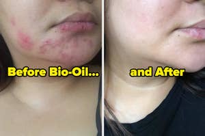 before and after images of a reviewer with acne scars disappearing