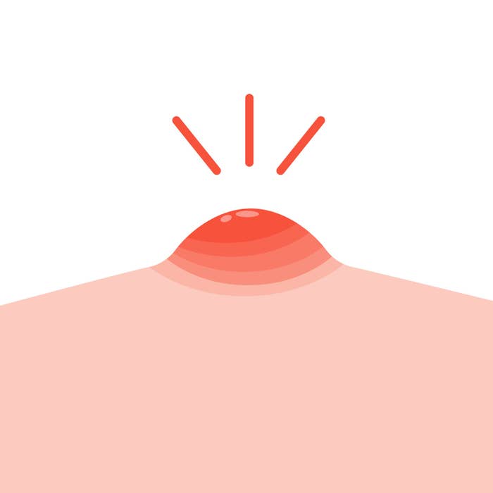 Flat vector illustration of pimple on skin. Pimple on face. Vector illustration