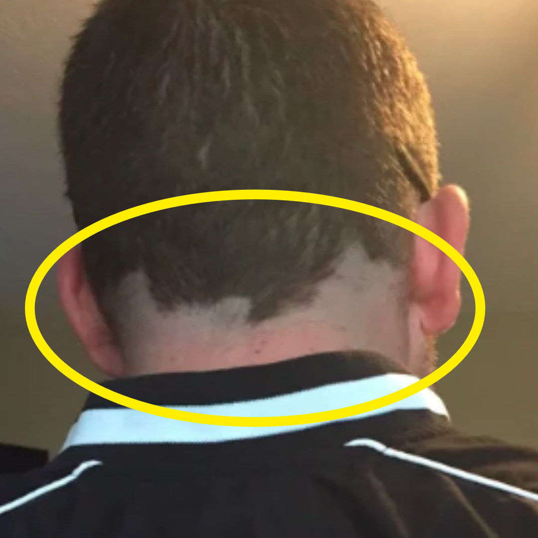 Close-up of a hairline thats very, very crooked and uneven