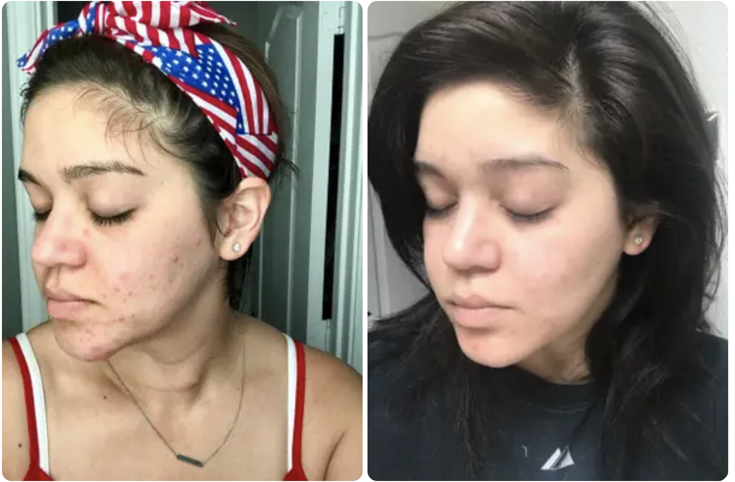 A reviewer with cheek and jaw acne before and cleared acne after