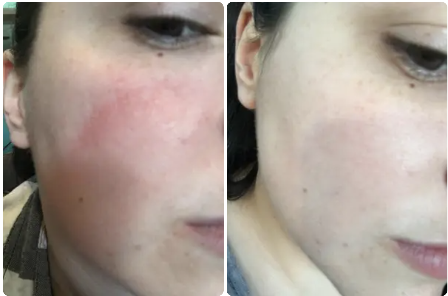 A reviewer&#x27;s cheek with red skin on the left and no redness on the right