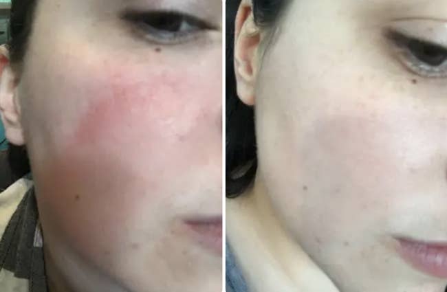 A reviewer's cheek with red skin on the left and no redness on the right