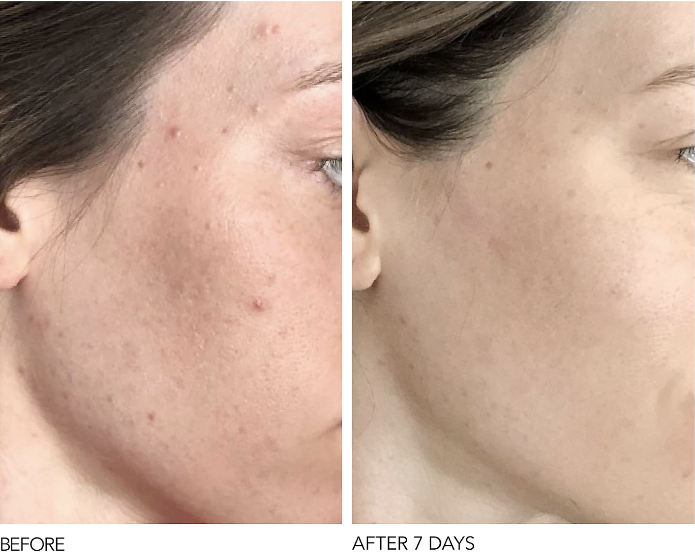 A model with acne and skin texture on their cheek on the left before use, and reduced acne and texture on the right after 7 days of use