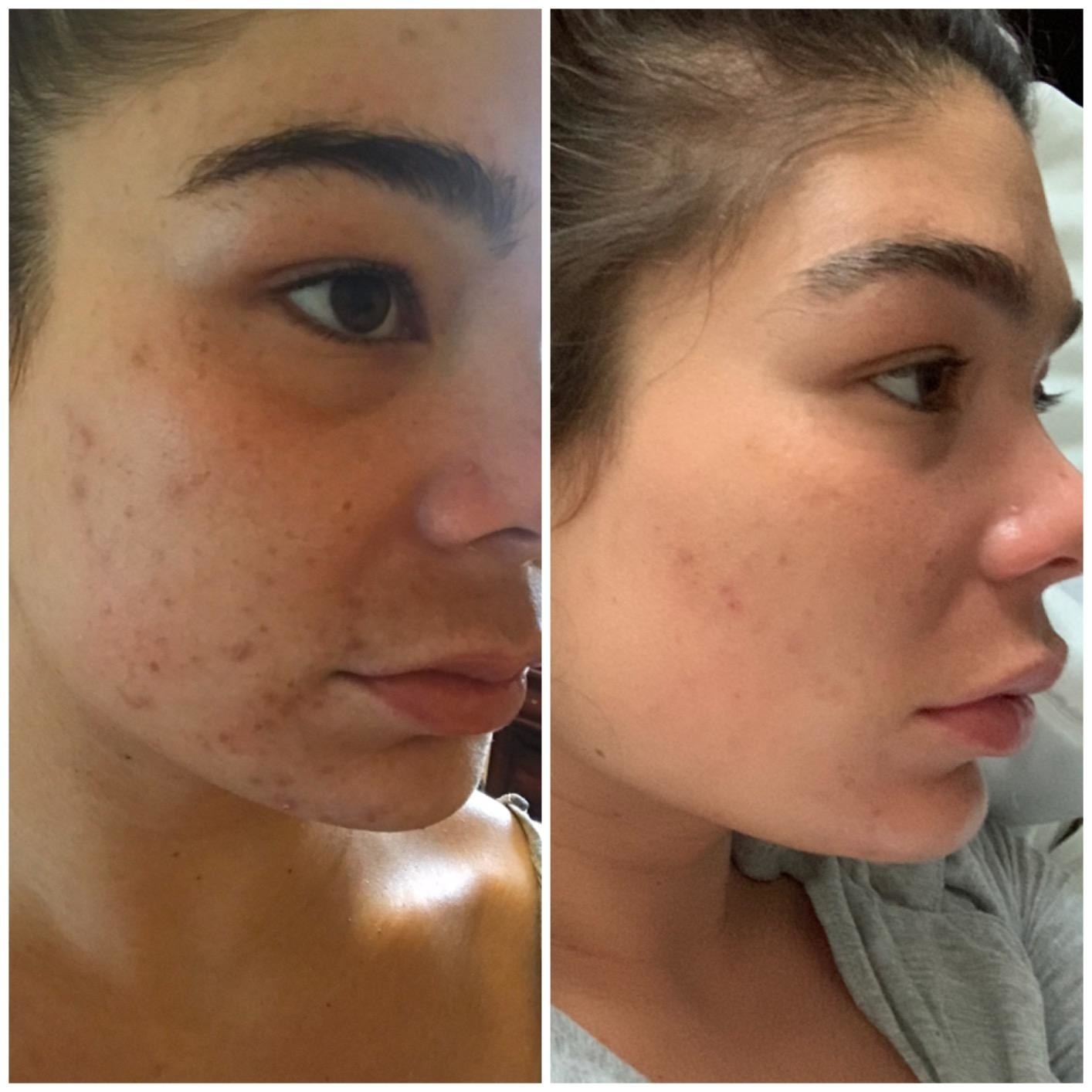 A reviewer&#x27;s skin before/after use, with reduced acne and acne marks
