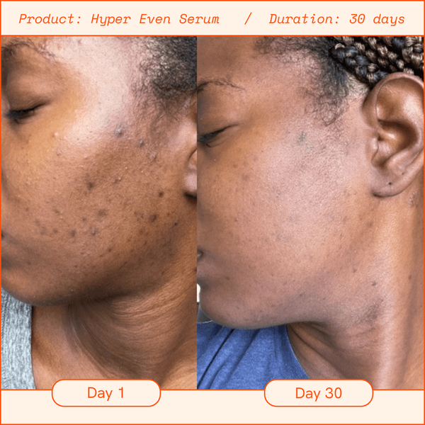 A before/after showing reduced dark spots and hyperpigmentation after 30 days