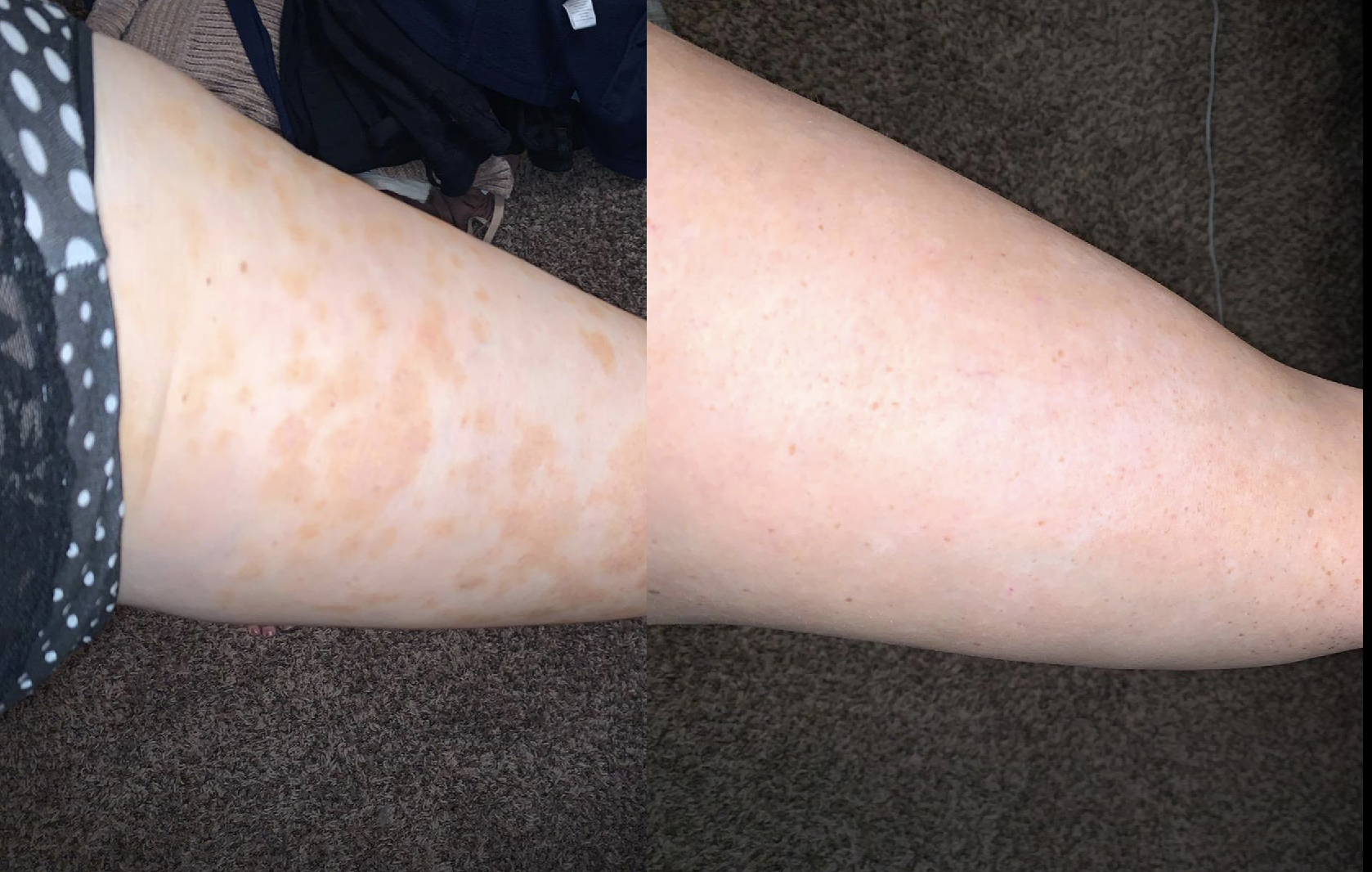 A reviewer&#x27;s leg with eczema splotches before and reduced after