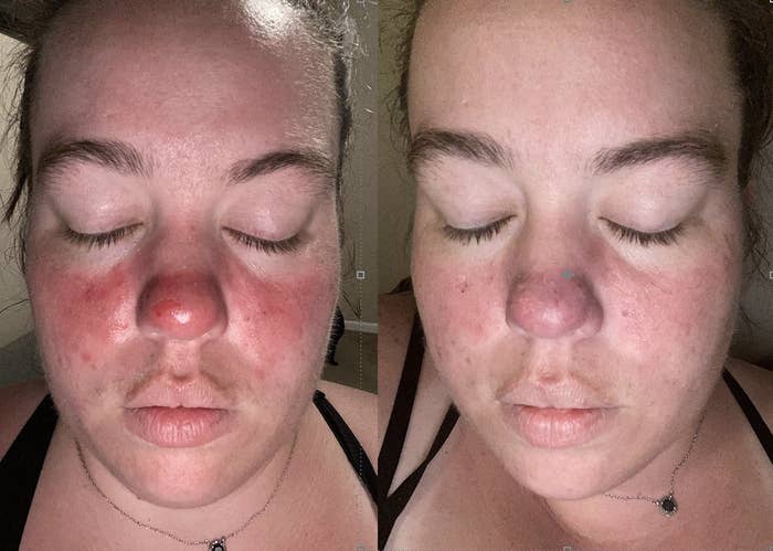 A reviewer with rosacea and peeling skin on the left, with reduced redness and irritation on the right