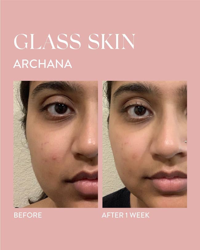 A before/after showing reduced acne after one week