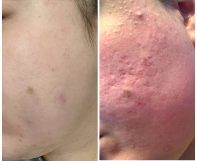 A reviewer's before/after with reduced redness, texture, acne and scarring