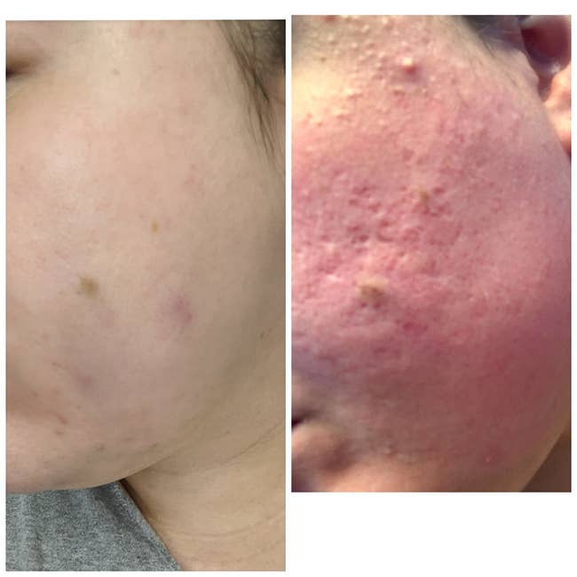 A reviewer's before/after with reduced redness, texture, acne and scarring