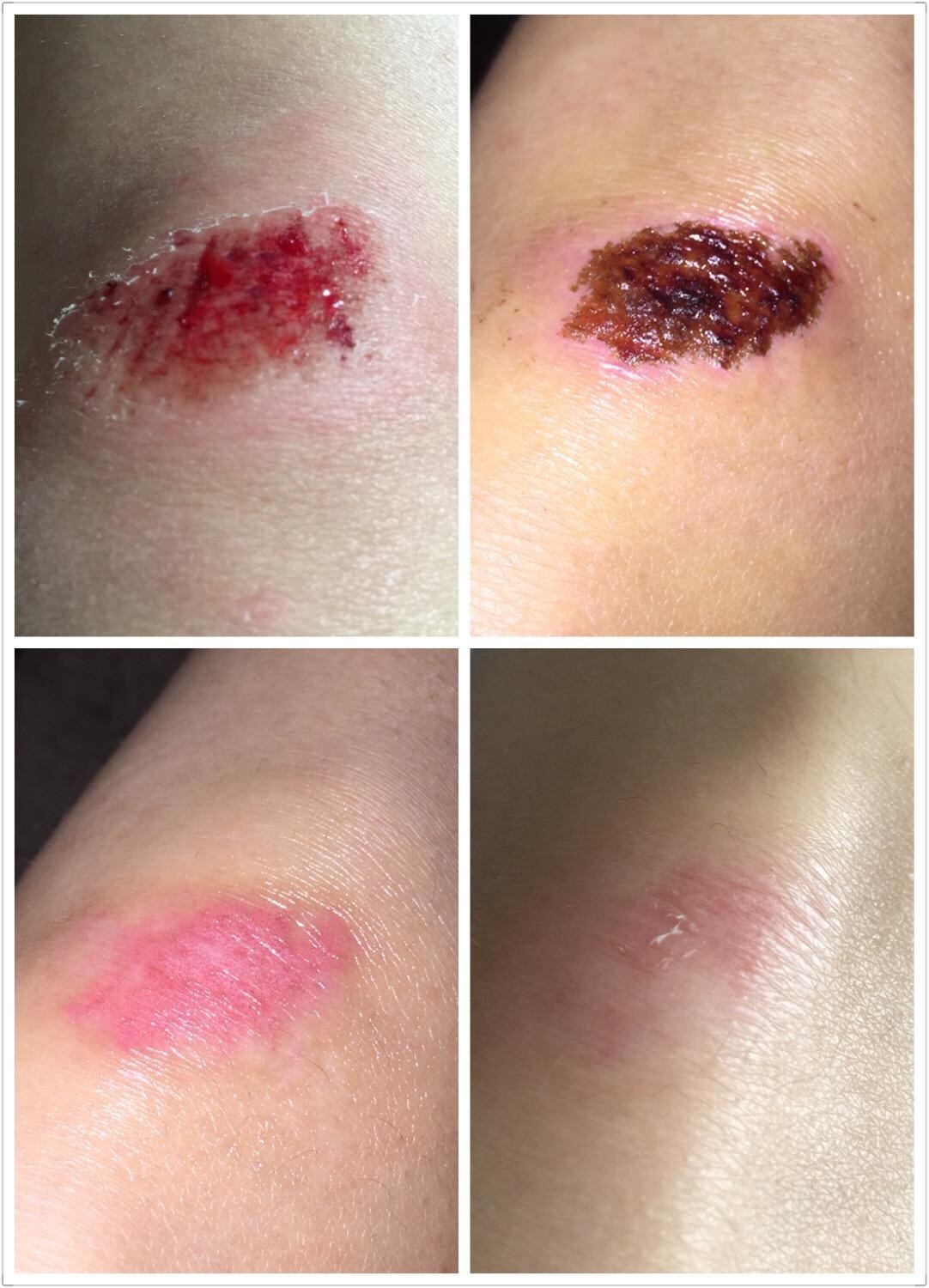 reviewer collage of a bloody scab healing