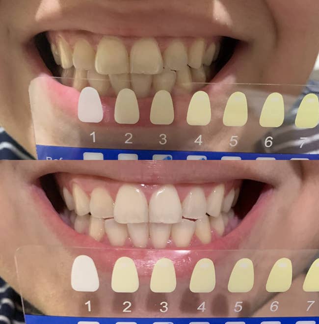 reviewer before and after with teeth noticeably whiter after first use