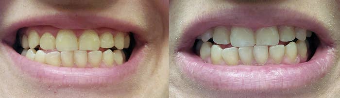 before and after images of a reviewer&#x27;s yellow teeth whitening