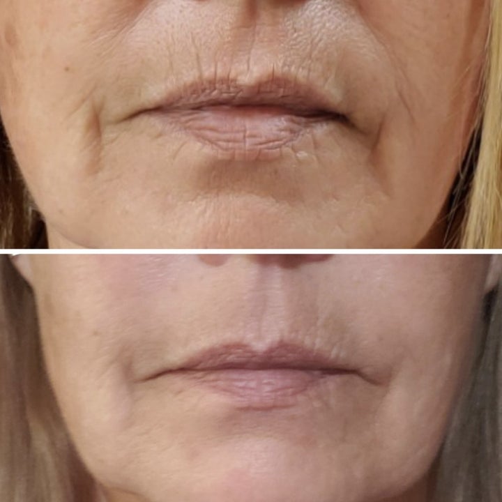 a reviewer's before and after images of the skin around their lips