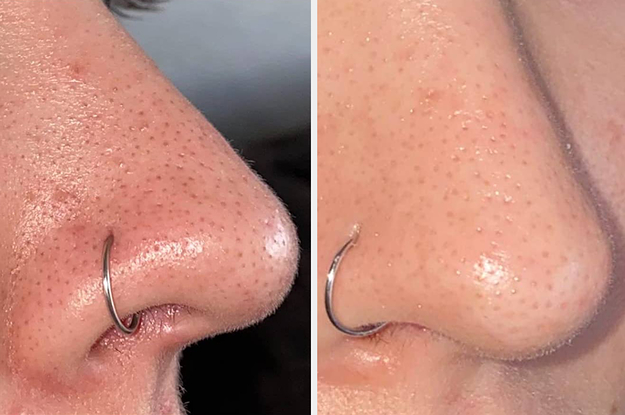 Reviewer's nose before and after using blackhead remover