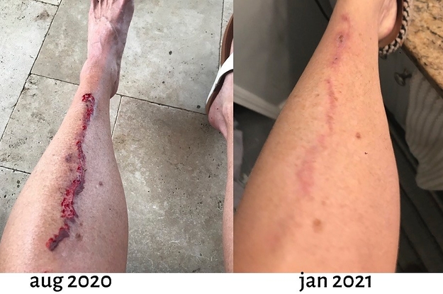 reviewer's large leg scar in august 2020, then it majorly faded in january 2021