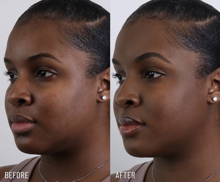a before and after where the after shows a noticeably smoother complexion