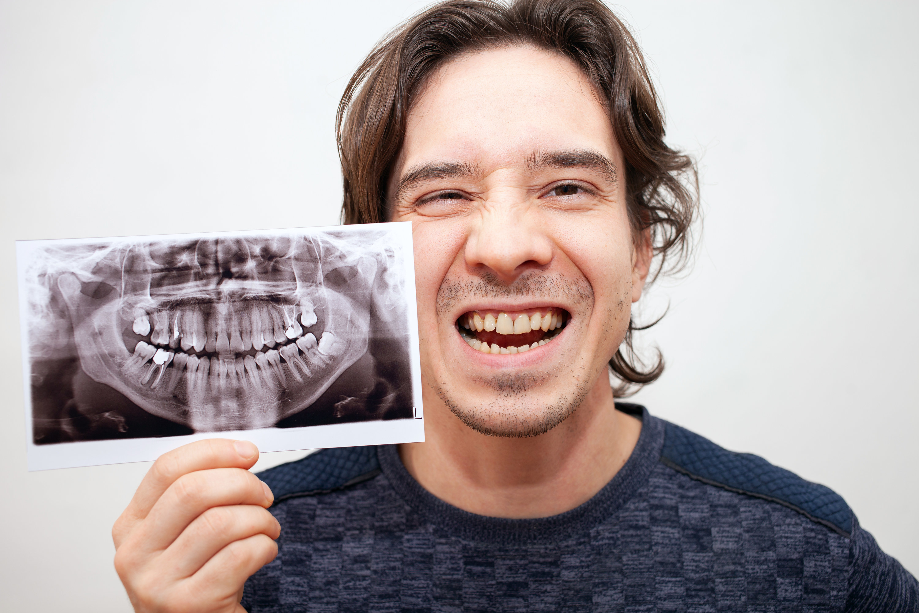 Smiling man holding an xray showing his impacted wisdom teeth