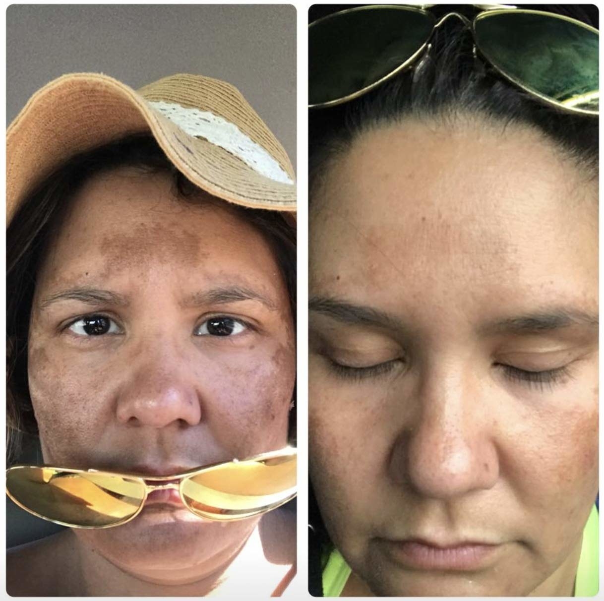 person with dark spots on face and then skin looking much lighter thanks to the product