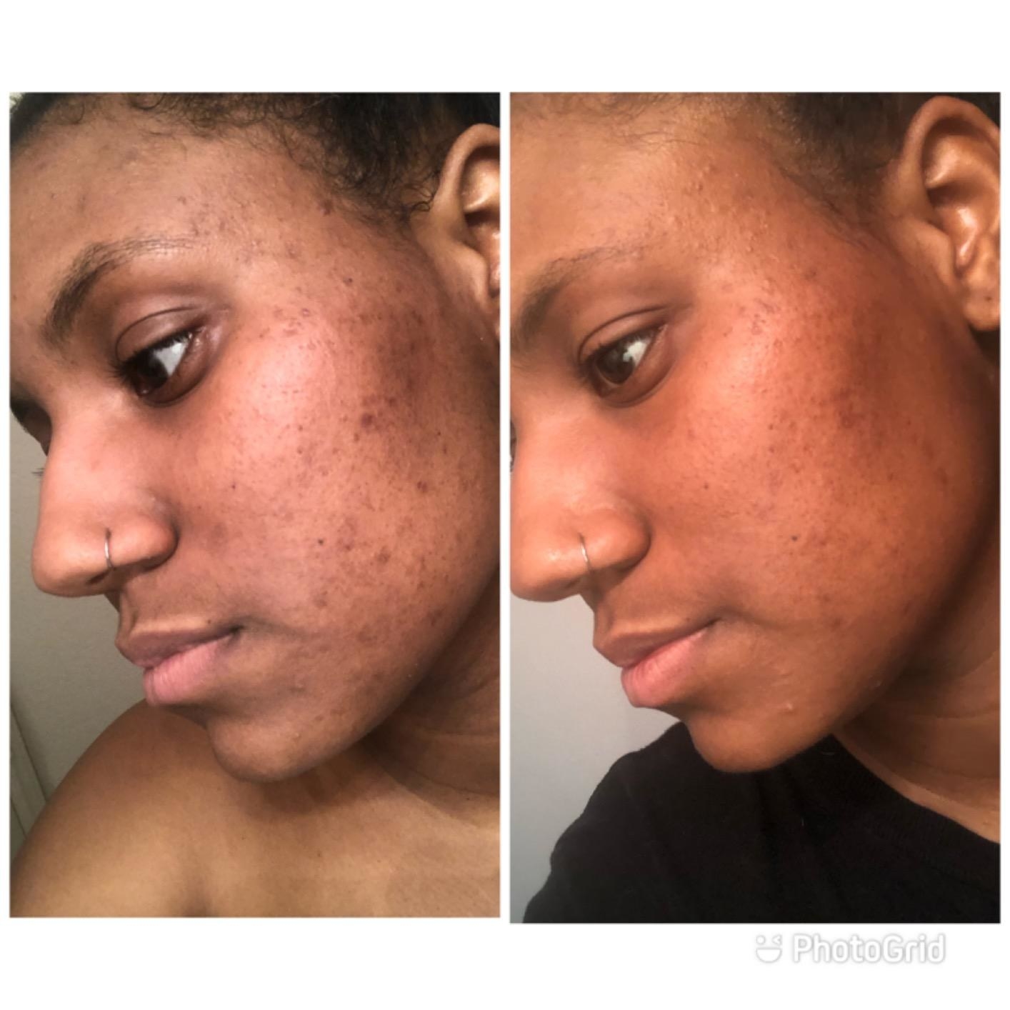 A reviewer&#x27;s skin before and after use, with reduced texture, acne, and redness after