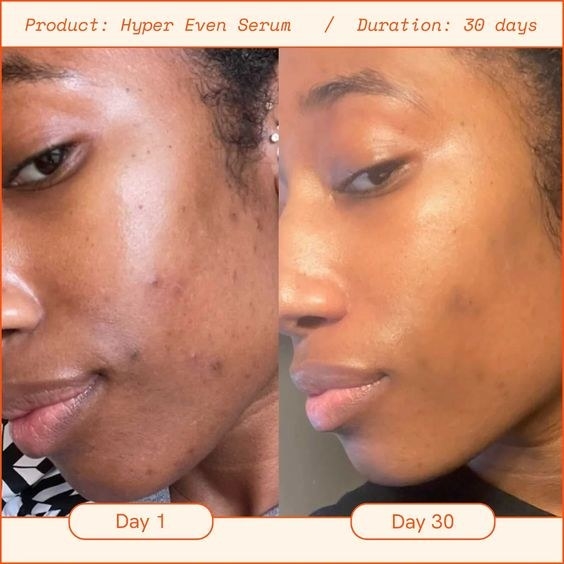 on the left a product user with breakouts captioned day 1, on the left the same user with clearer skin captioned day 30