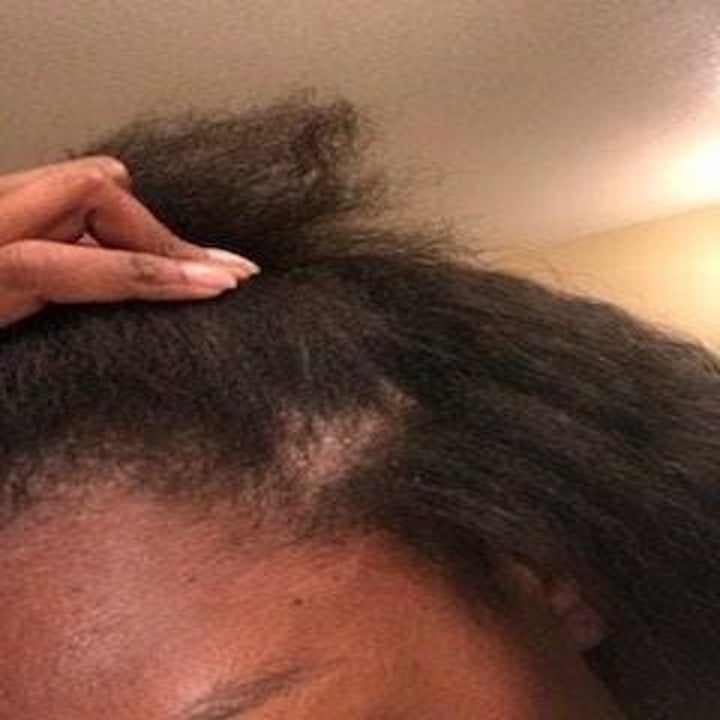 Reviewer after using the anti-dandruff shampoo