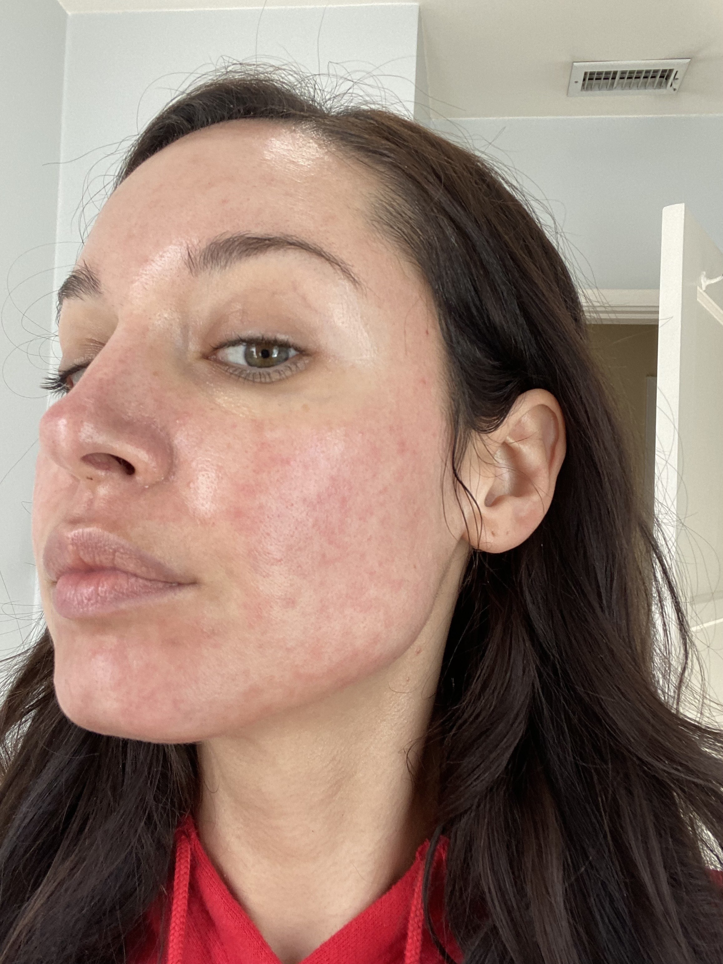 I Developed Rosacea And Hyperpigmentation After Laser Treatment