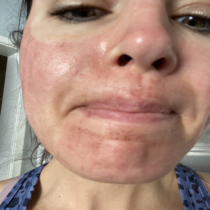 Krista Torres with red skin.