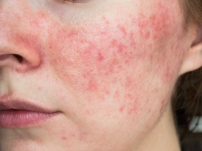 Rosacea on someone&#x27;s skin.