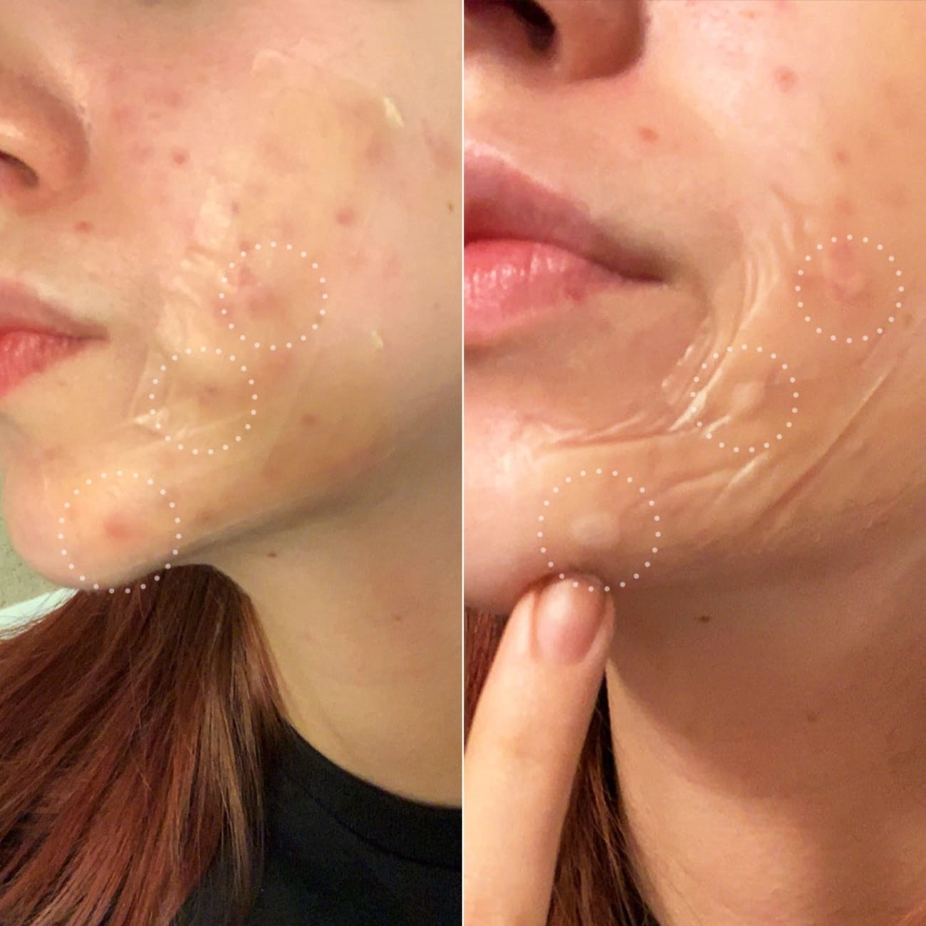 A person with the strip on their face showing the gunk being sucked out of pimples