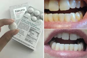 gum and whitened teeth 