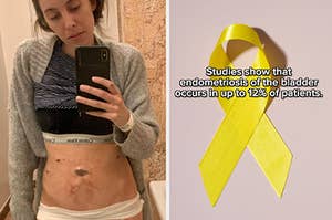 image of the author after surgery for endometriosis on the left, next to a yellow ribbon depicting endo awareness on the right