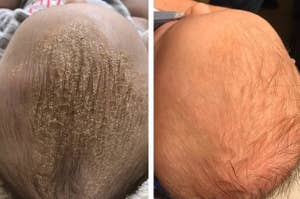 on left, "before" picture of dry skin on baby's scalp. on right, "after" picture of same baby's scalp with less cradle cap after using soft comb