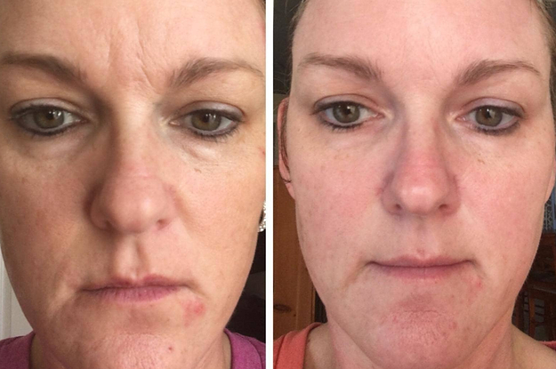 on left, reviewer with lines on forehead and dark puffy circles under eyes. on right, same reviewer with less forehead lines and dark puffy circles after using vitamin C serum